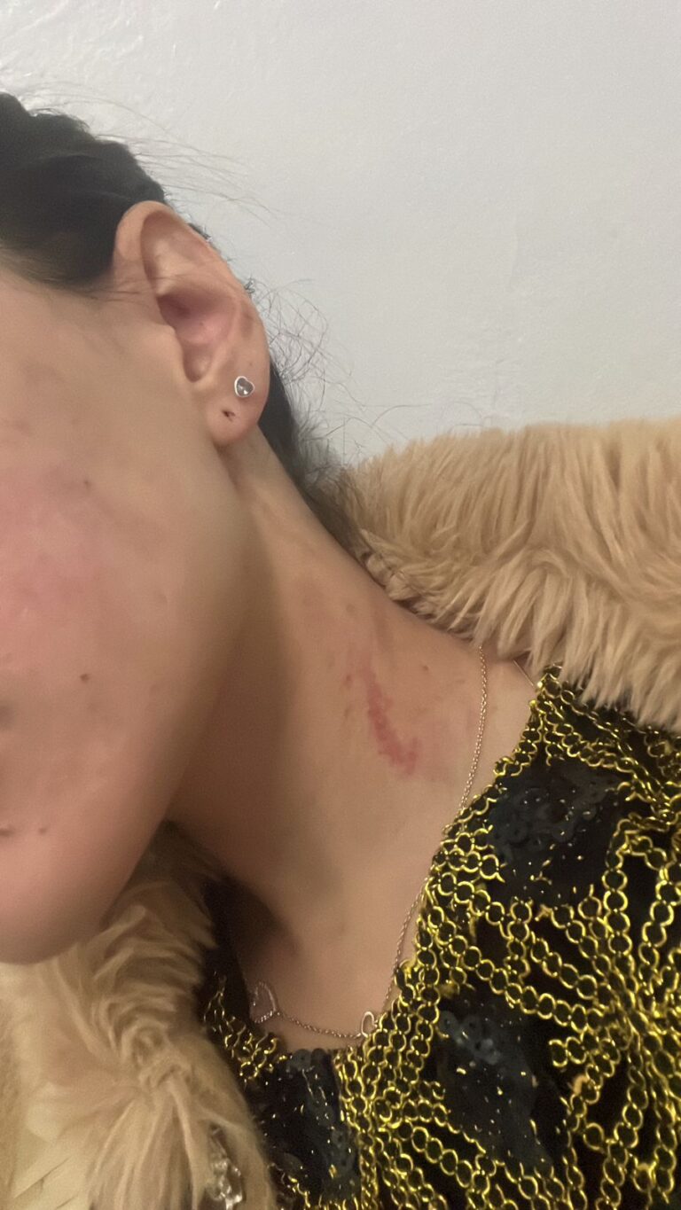 Una joven denunció a su pareja por golpearla con rudeza: Lo detuvieron pero ella decidió irse de Carlos Paz